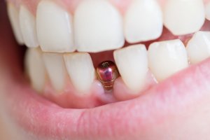 Dental Implants