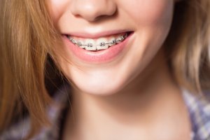 girl showing dental braces.