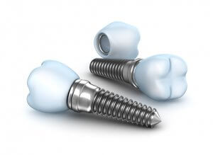 Dental Implants