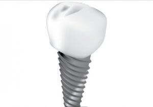 Dental Implant