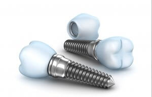 Dental Implants