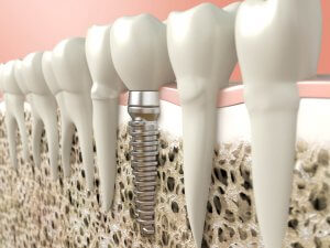 bone graft implant