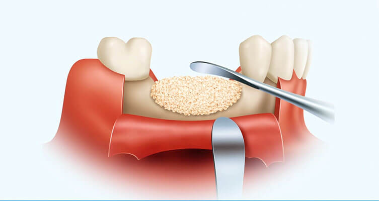 Bone Grafting