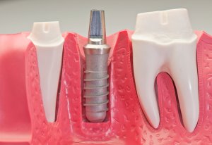 gums dental implant