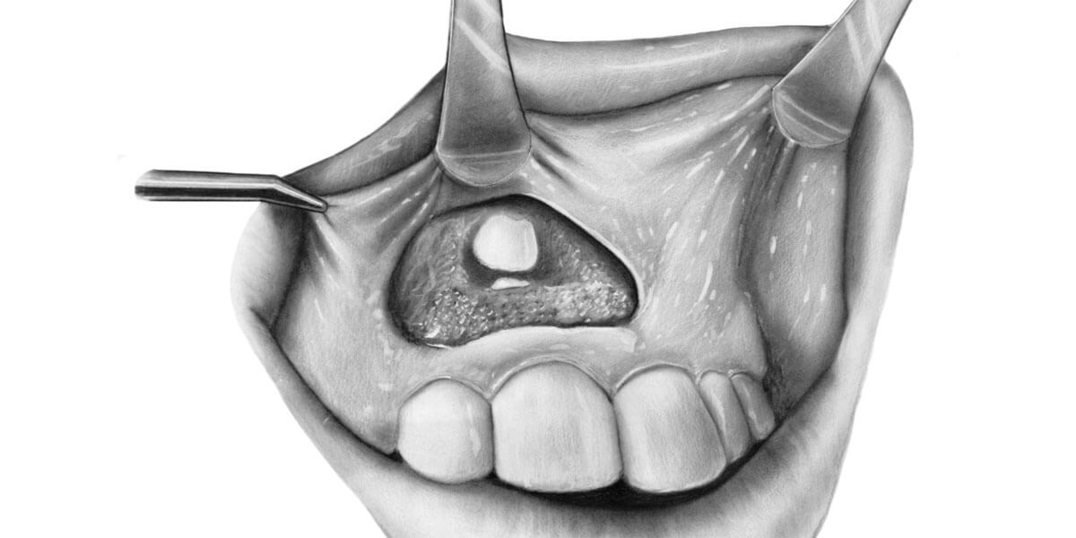 Impacted Tooth & Tooth Exposure