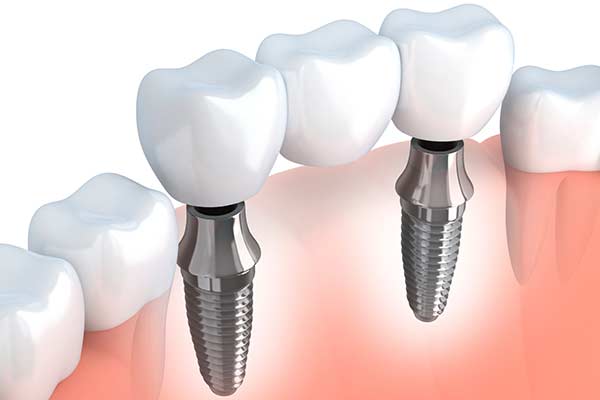 Dental Implants