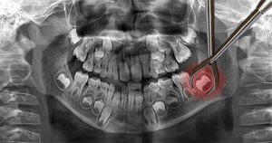 xray-teeth